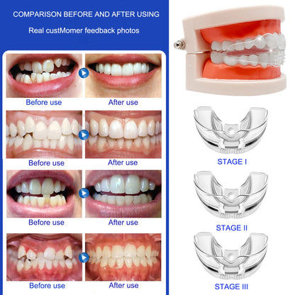 Orthodontic Braces Smile Trainer - Instant Silicone Teeth Retainer Mouth Guard for Teeth Alignment