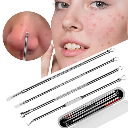 4 Piece Blackhead and Acne Remover Set - Squeezing Tools, Acne Needles, Tweezers and Pore Cleaners for Effective Skin Care