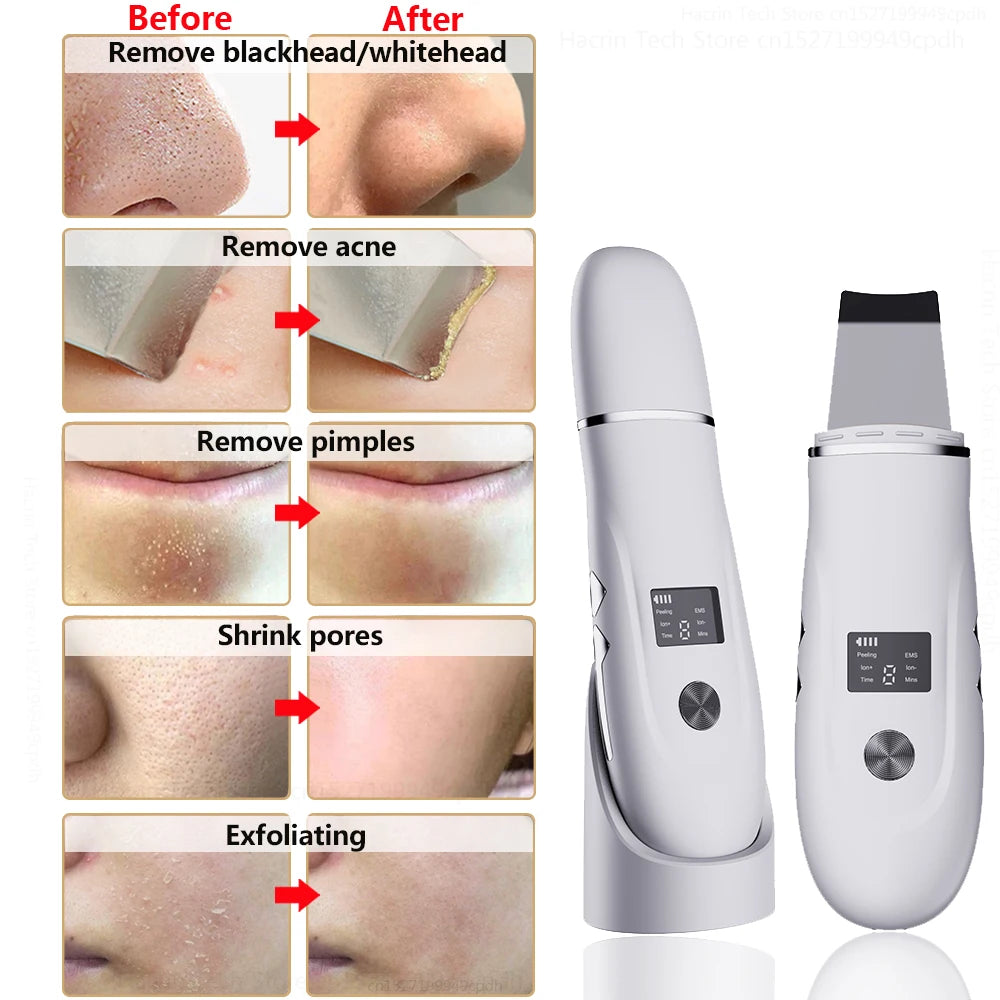 Ultrasonic Peeling Remover: Blackhead Facial Skin Scrubber Shovel for Deep Cleaning, Face Lifting, Pore Acne Removal - EMS Lift