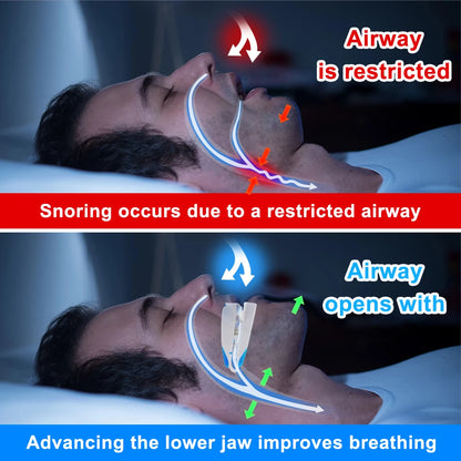 Adjustable Anti-Snoring Mouth Guard | Sleeping Device to Stop Snoring & Improve Sleep Quality