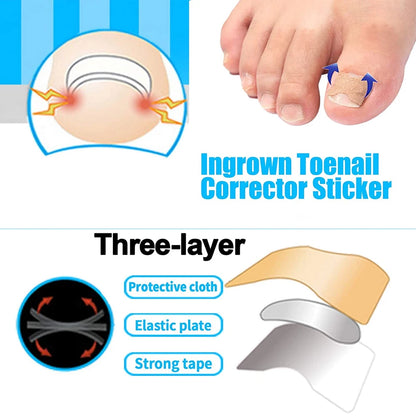 Ingrown Toenail Correction Patch Stickers Set - Pedicure Tool for Toe Nail Treatment and Foot Care