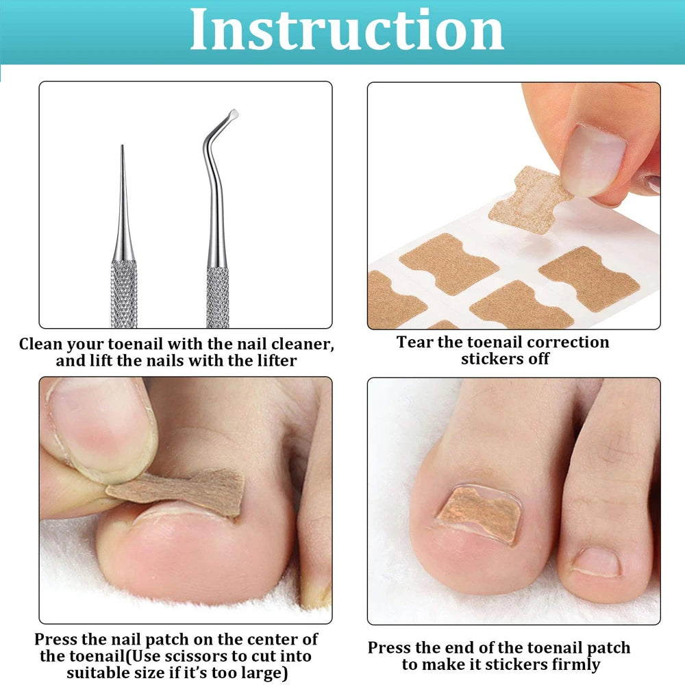 Ingrown Toenail Correction Patch Stickers Set - Pedicure Tool for Toe Nail Treatment and Foot Care