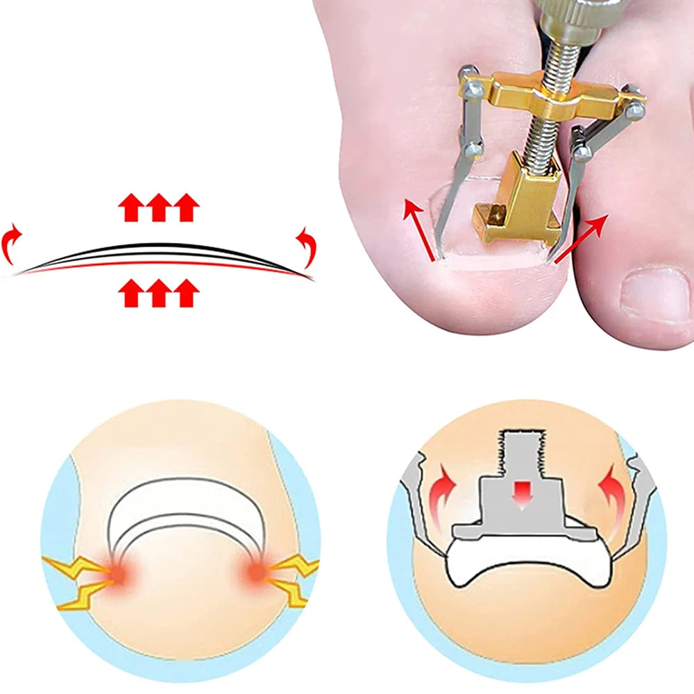 Ingrown Toenail Correction Patch Stickers Set - Pedicure Tool for Toe Nail Treatment and Foot Care